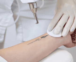 Refurbished Laser Tattoo Removal Machines
